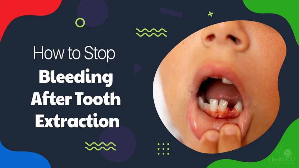 How to Stop Bleeding After Tooth Extraction at Home