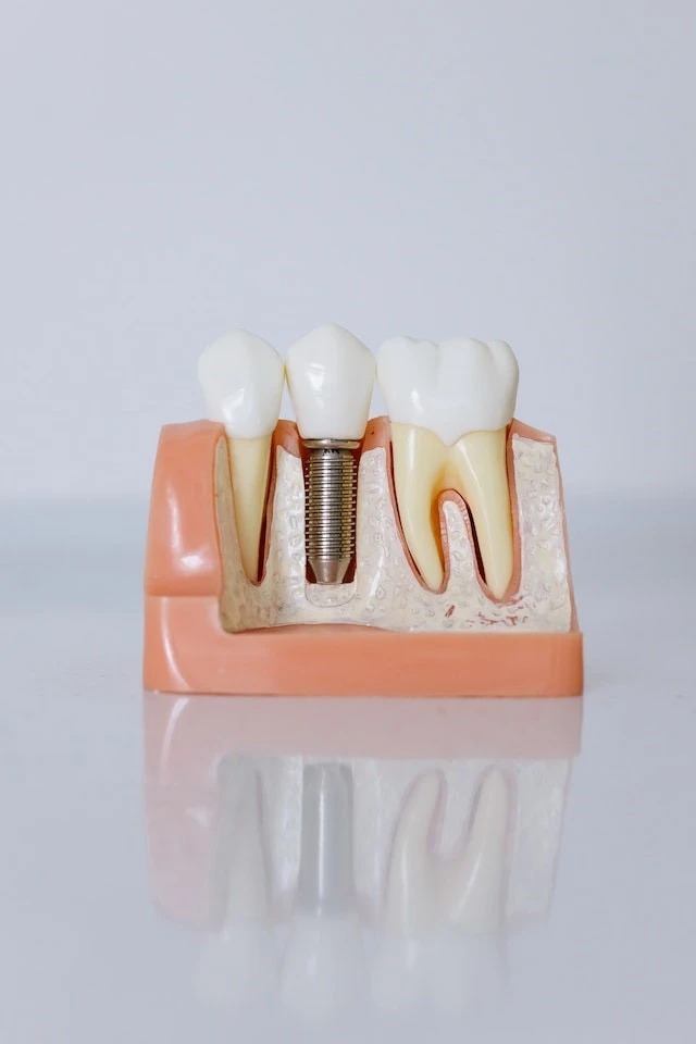 Dental Implants-2